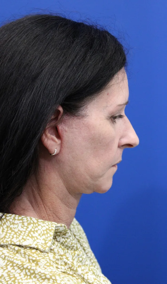 Facelift Before & After Patient #4957