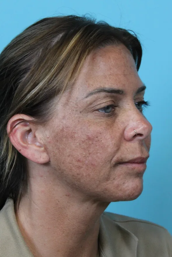 Deep Neck Lift Before & After Patient #5006