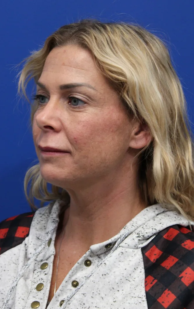 Deep Neck Lift Before & After Patient #5006