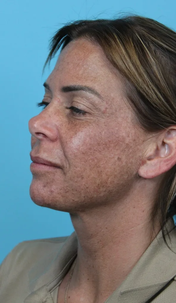 Deep Neck Lift Before & After Patient #5006