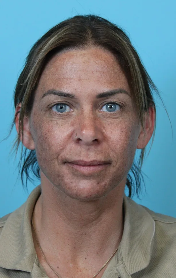 Deep Neck Lift Case 5006: after