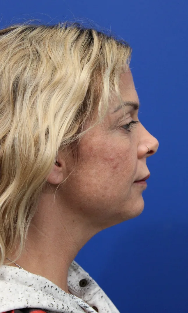 Deep Neck Lift Before & After Patient #5006