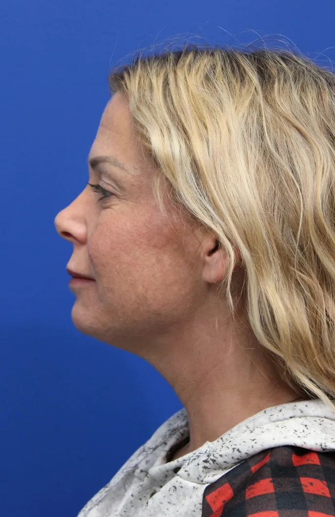 Deep Neck Lift Before & After Patient #5006