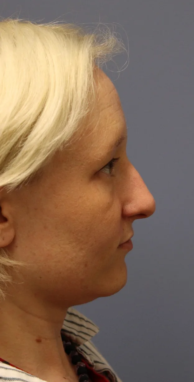 Revision Rhinoplasty Case 5028: before
