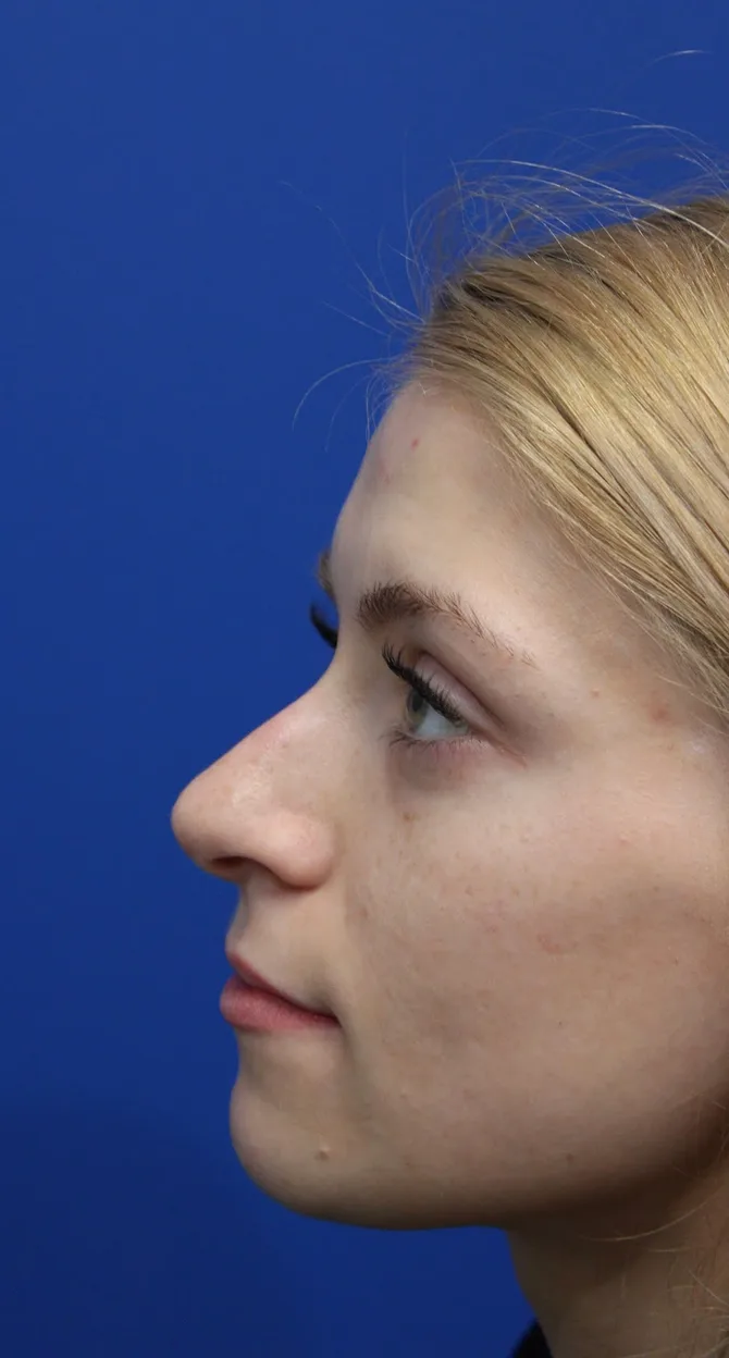 Revision Rhinoplasty Before & After Patient #5029