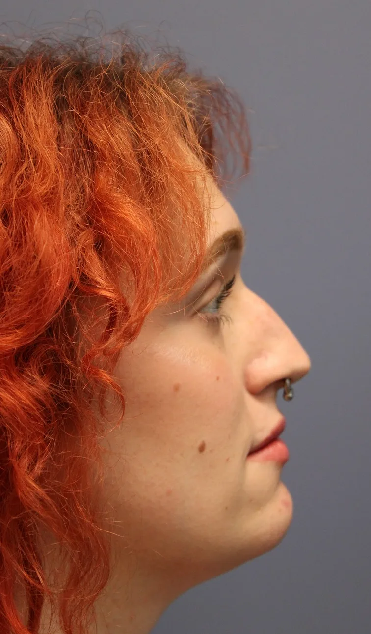 Rhinoplasty Before & After Patient #5053