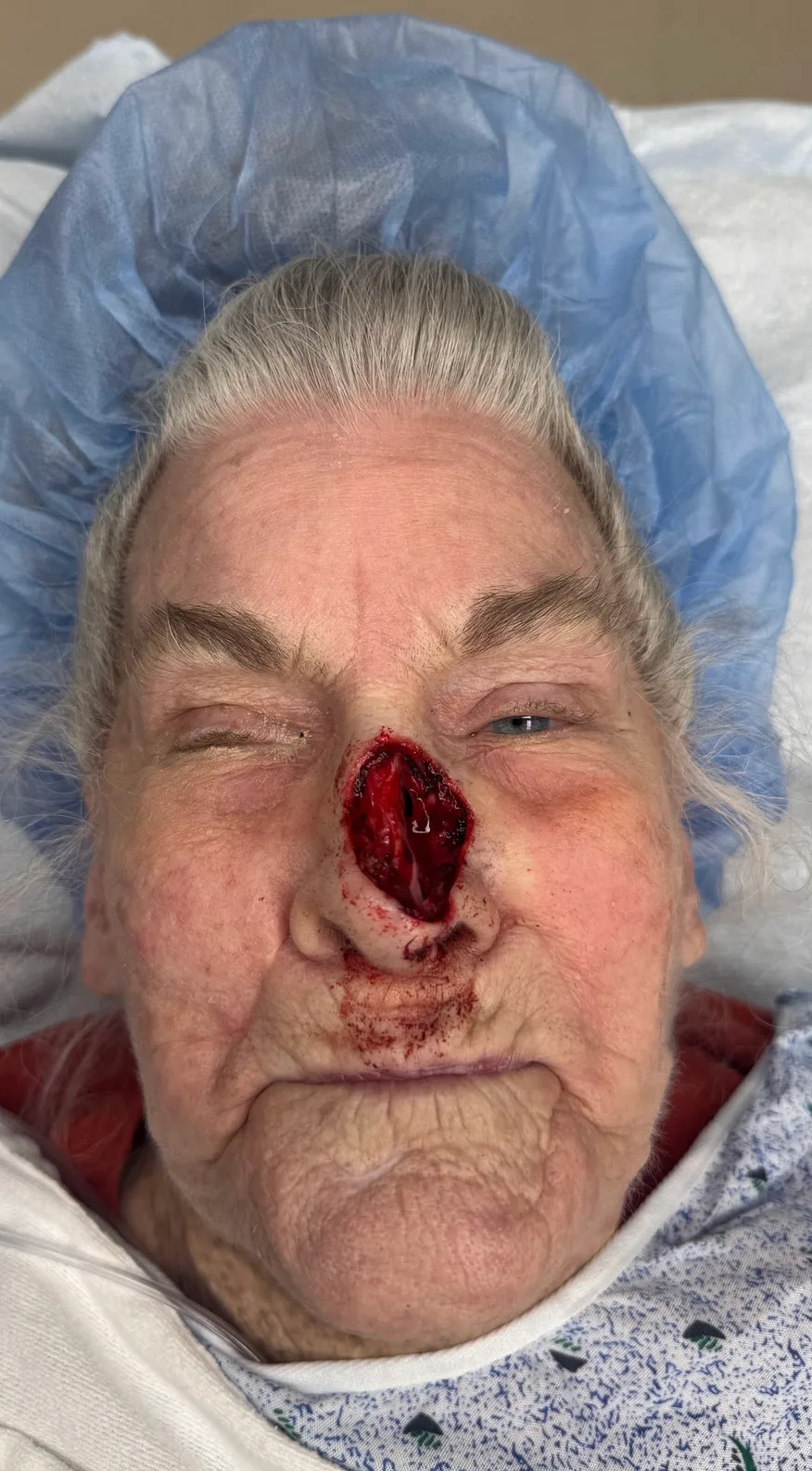 Mohs Surgery Before & After Patient #5055