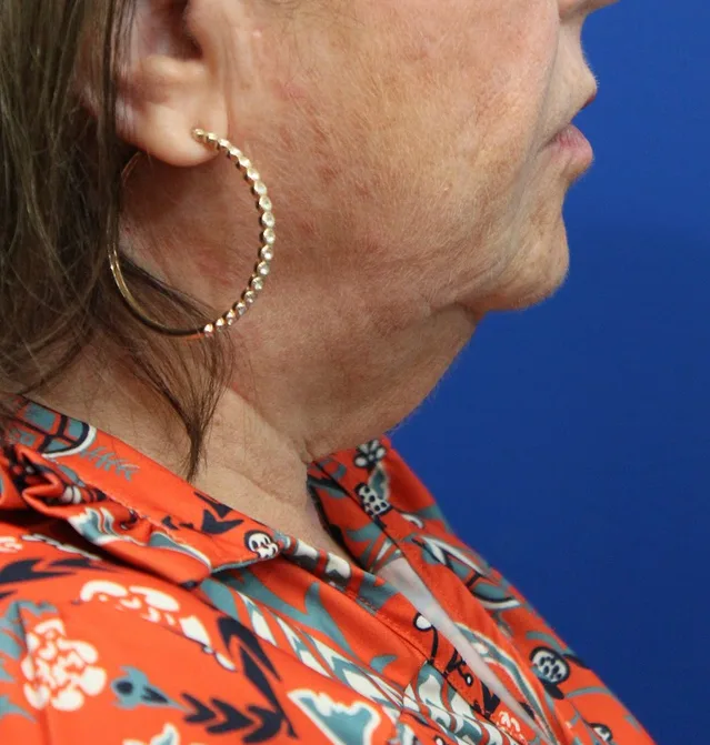 Anterior Neck Lift Case 5027: before