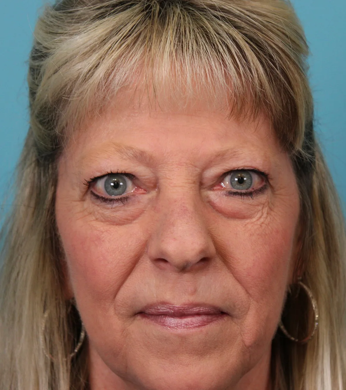 Upper Blepharoplasty Before & After Patient #5052