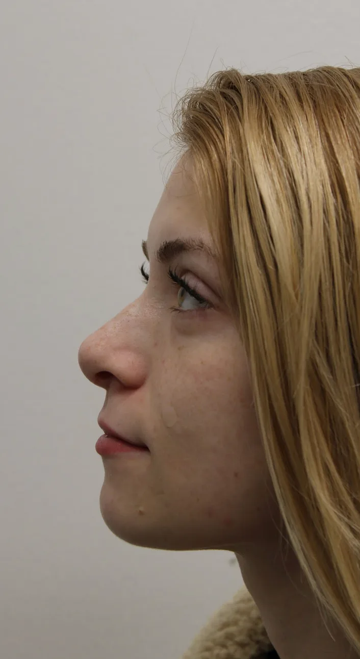 Revision Rhinoplasty Before & After Patient #5029