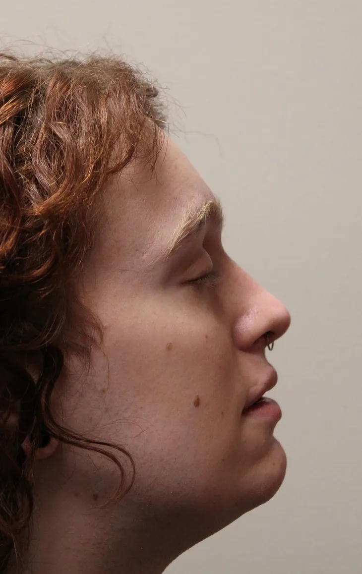 Rhinoplasty Before & After Patient #5053