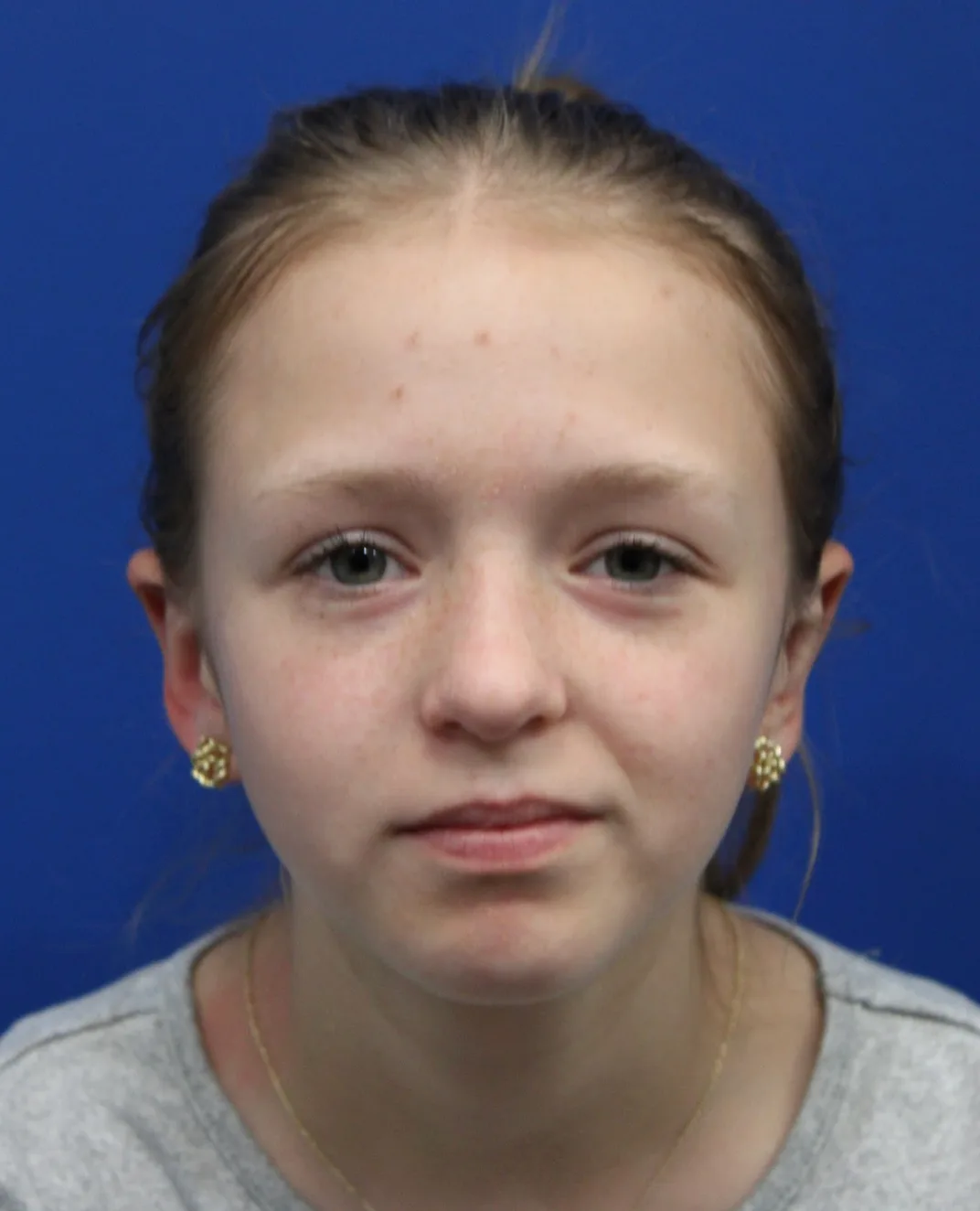 Otoplasty Before & After Patient #5054