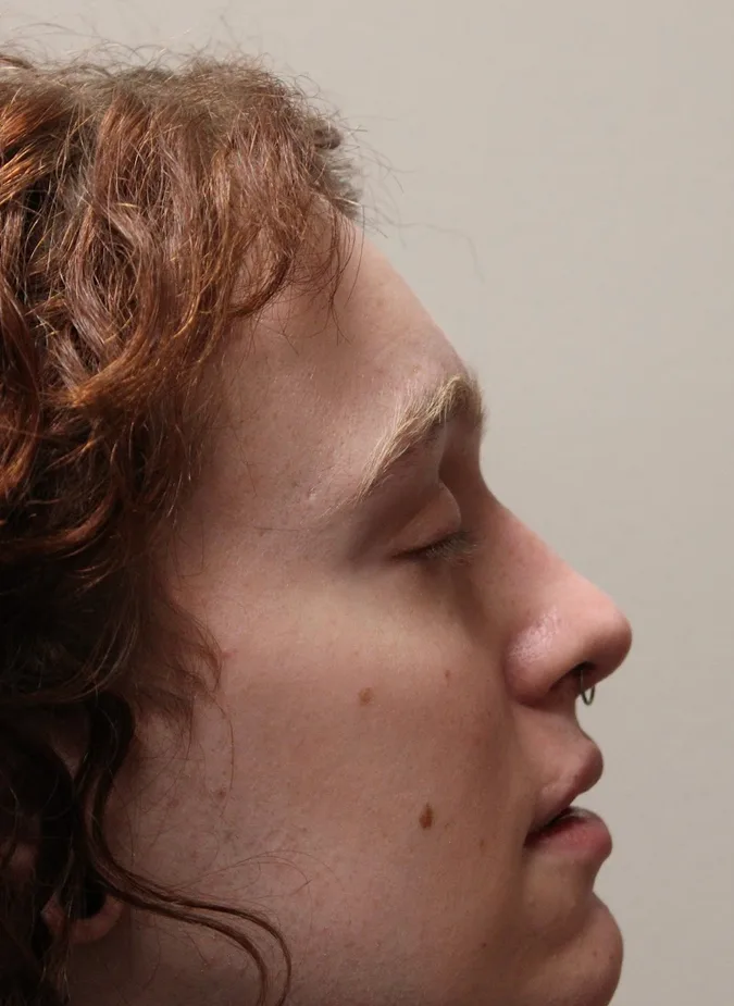 Facial Feminization Before & After Patient #5031