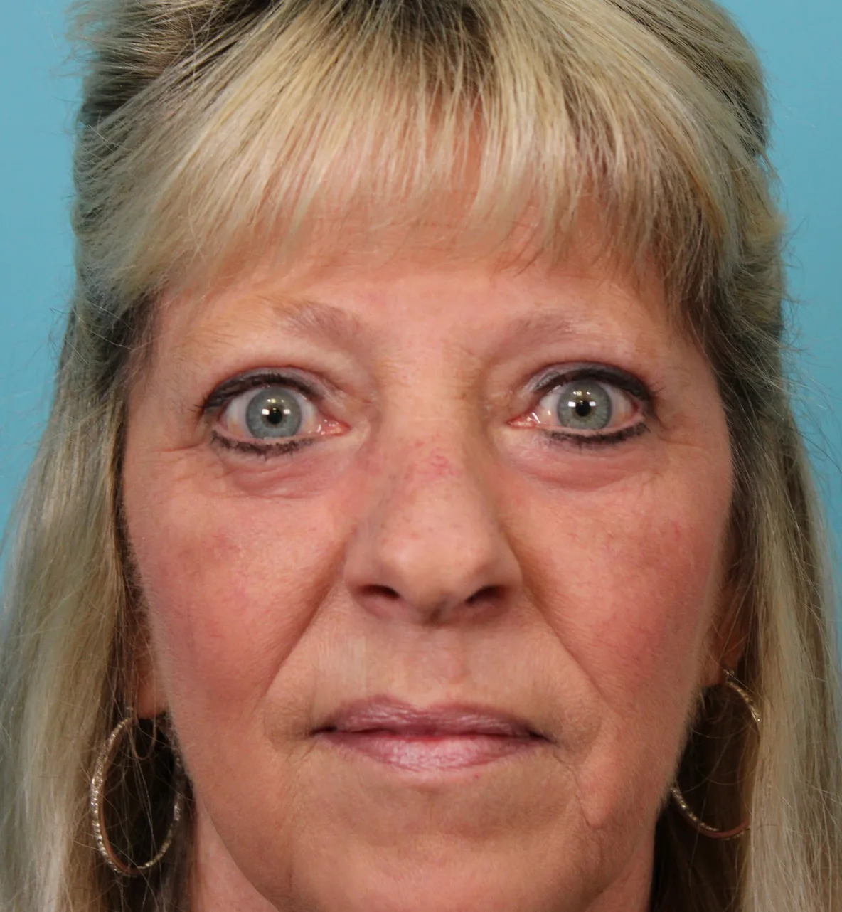 Lower Blepharoplasty Case 5030: after