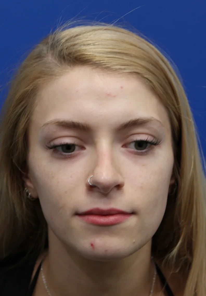 Revision Rhinoplasty Before & After Patient #5029