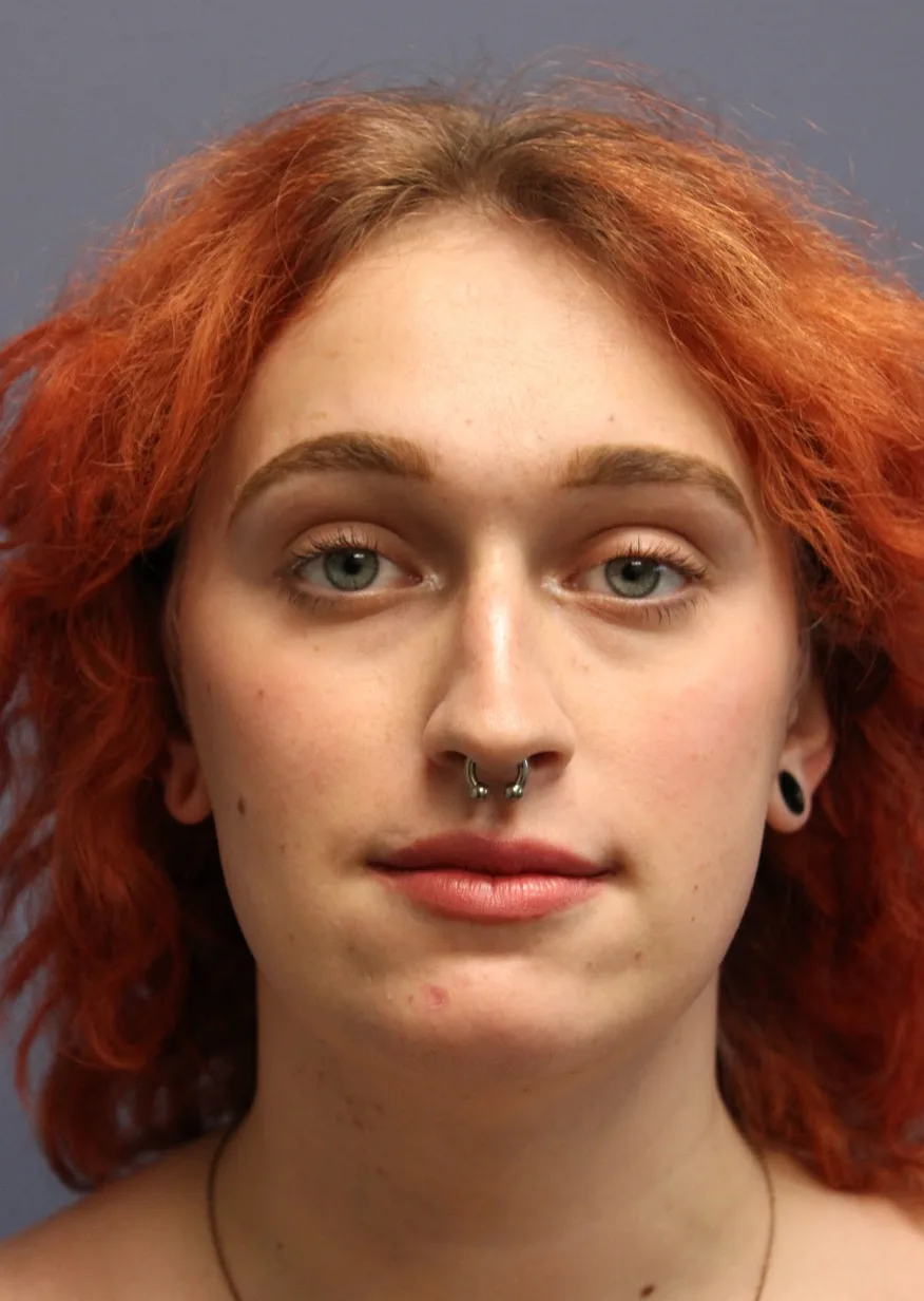 Rhinoplasty Before & After Patient #5053