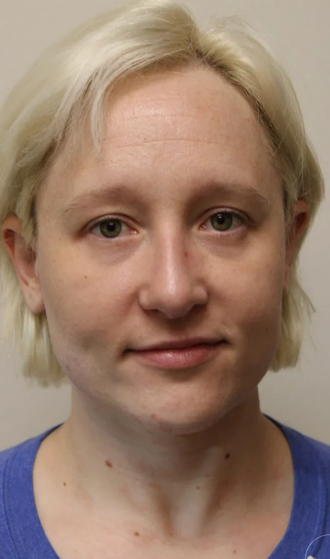Revision Rhinoplasty Before & After Patient #5028