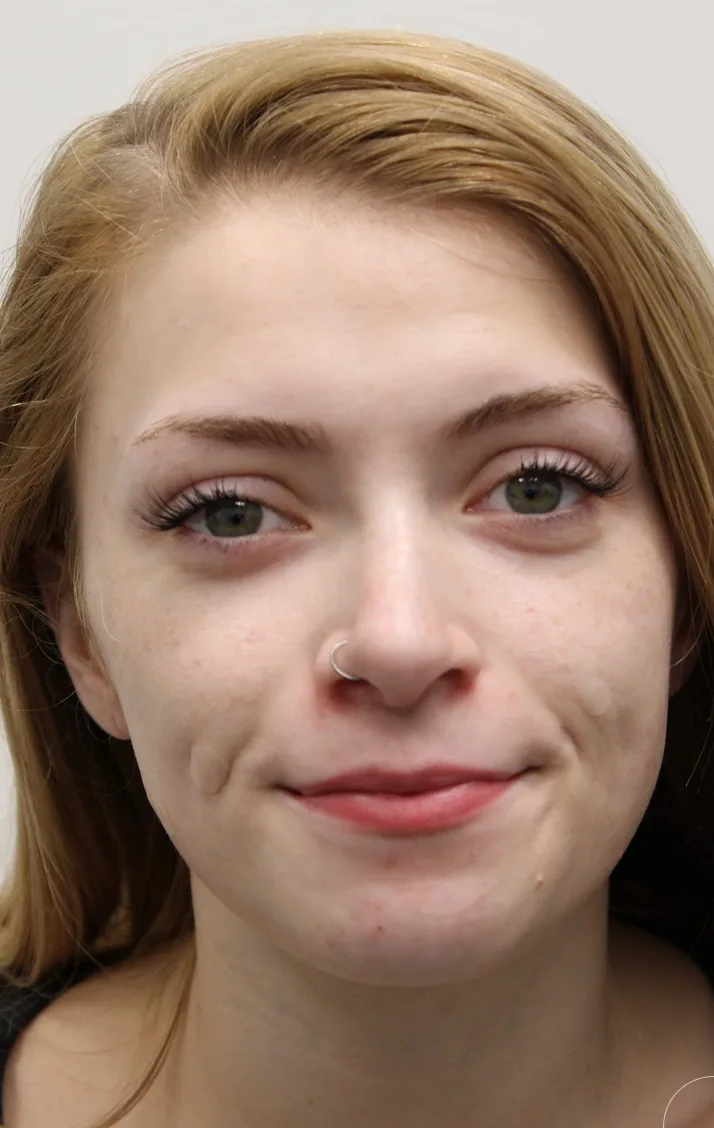 Revision Rhinoplasty Before & After Patient #5029