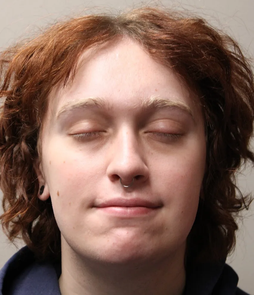 Rhinoplasty Before & After Patient #5053