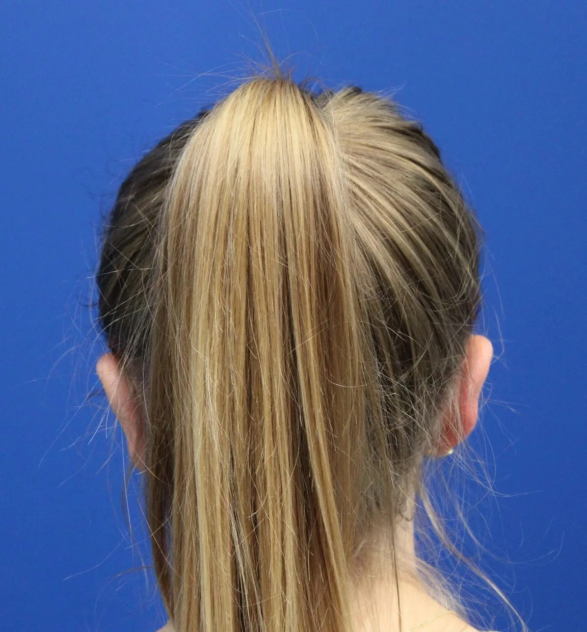 Otoplasty Before & After Patient #5054