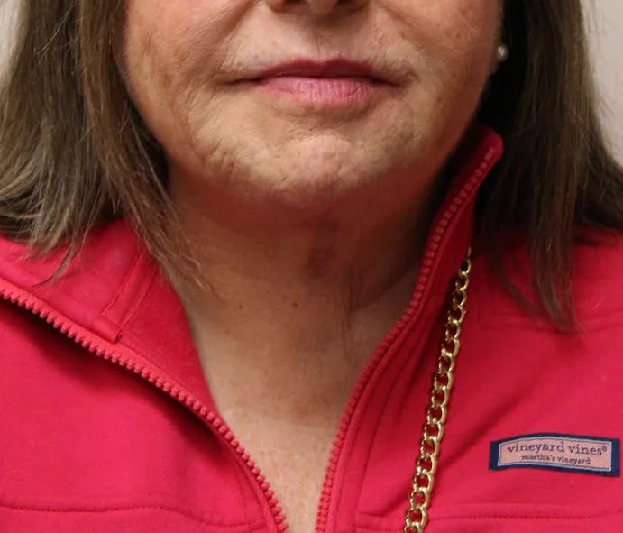 Anterior Neck Lift Before & After Patient #5027