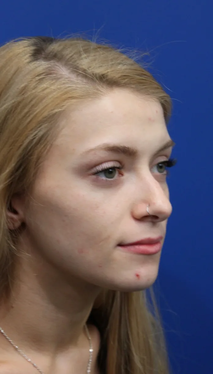 Revision Rhinoplasty Before & After Patient #5029