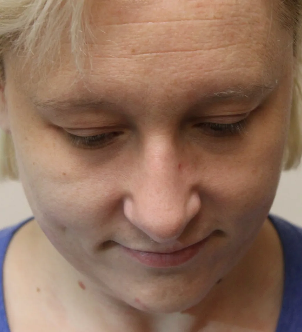 Revision Rhinoplasty Before & After Patient #5028