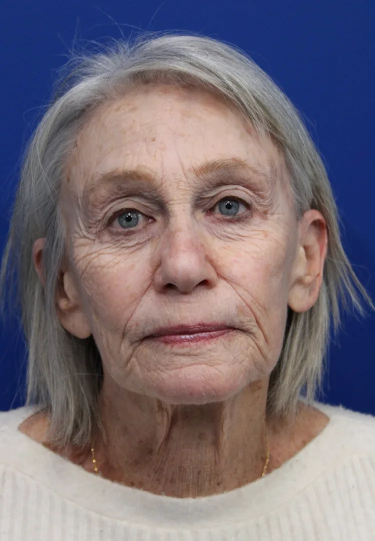 Laser Resurfacing Case 5091: before