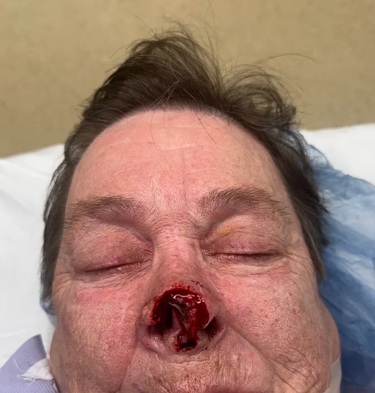 Mohs Surgery Before & After Patient #5069