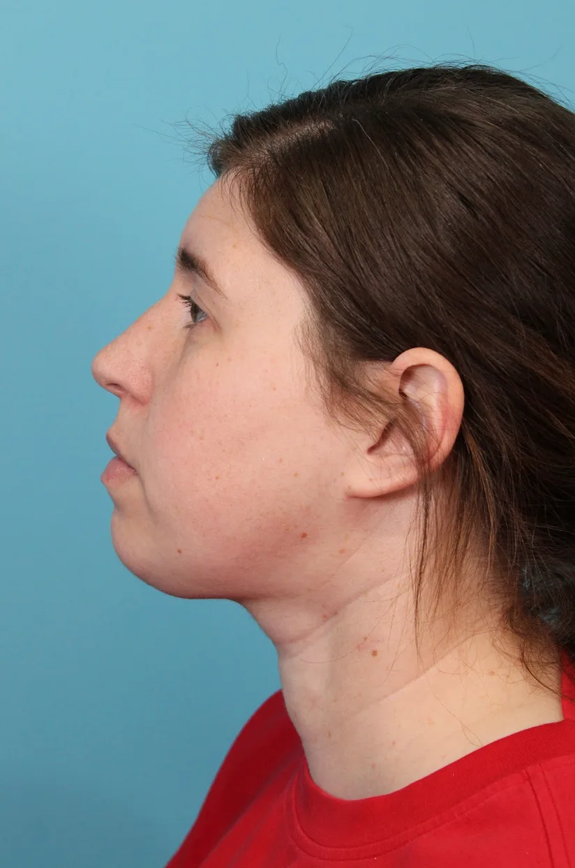 Submental Liposuction Before & After Patient #5074