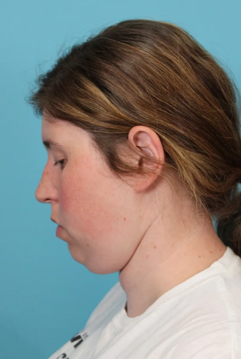 Submental Liposuction Before & After Patient #5074