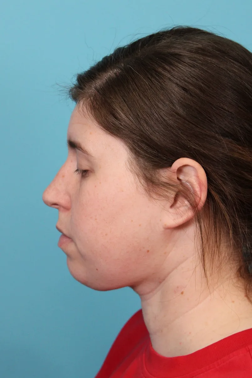 Submental Liposuction Before & After Patient #5074