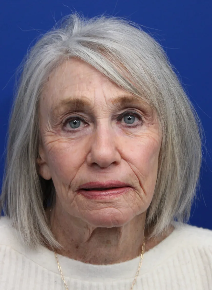 Laser Resurfacing Case 5091: after