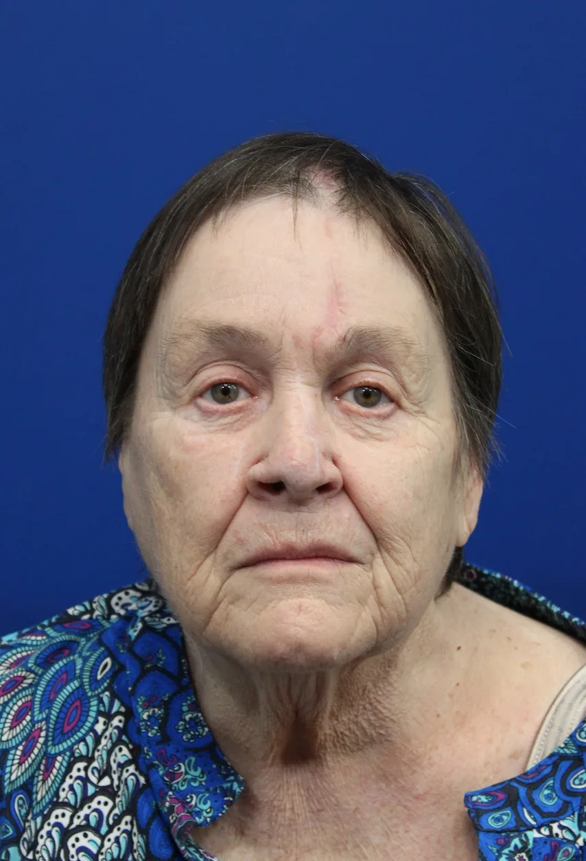 Mohs Surgery Before & After Patient #5069