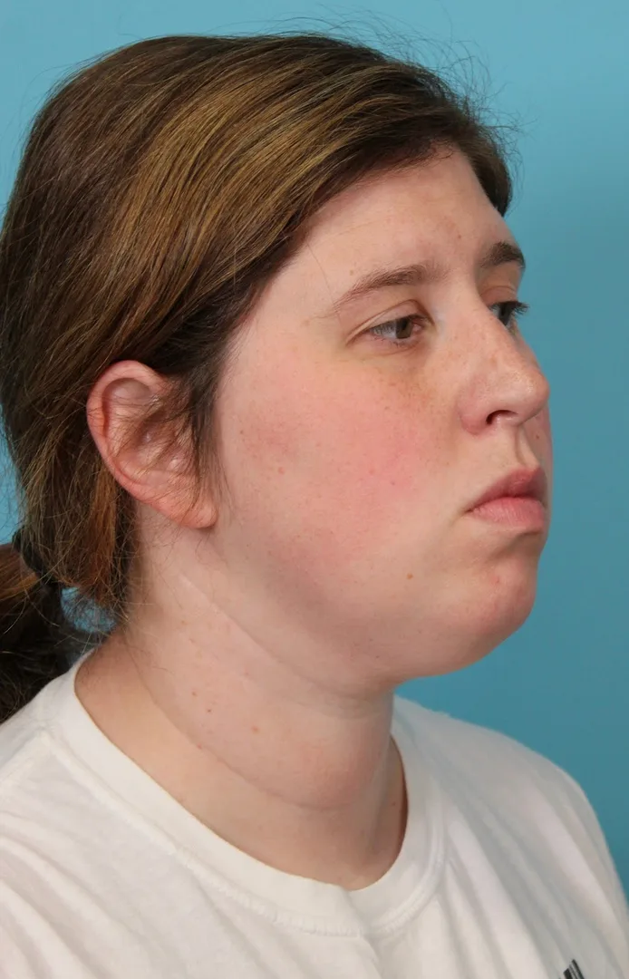Submental Liposuction Before & After Patient #5074