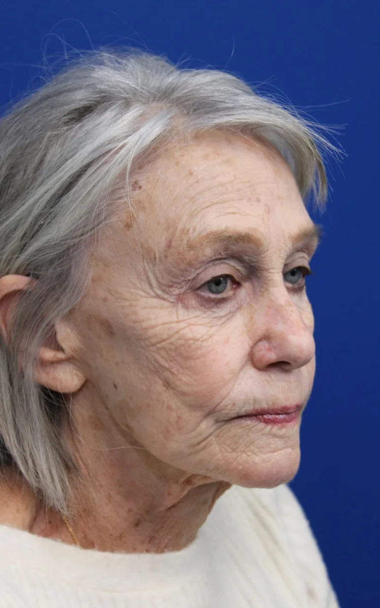Laser Resurfacing Before & After Patient #5091