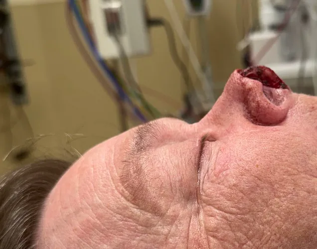 Mohs Surgery Before & After Patient #5069