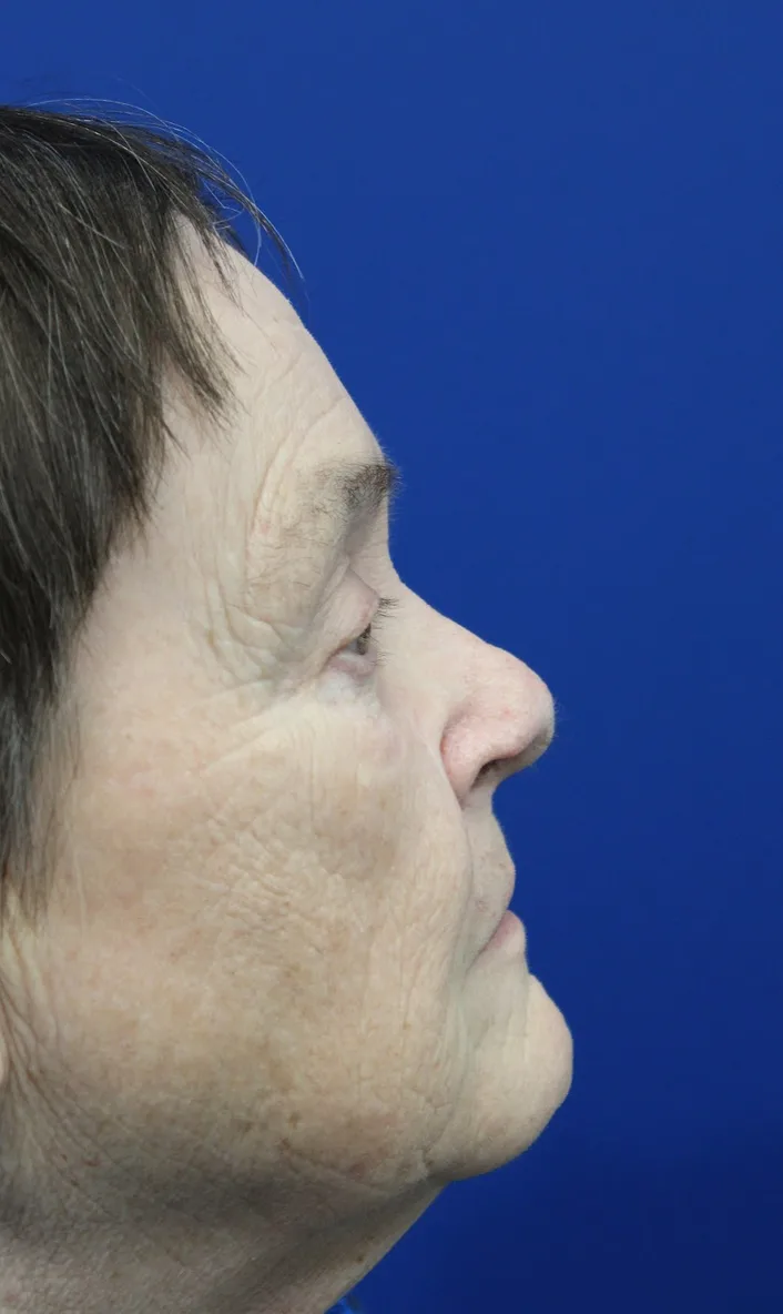Mohs Surgery Before & After Patient #5069
