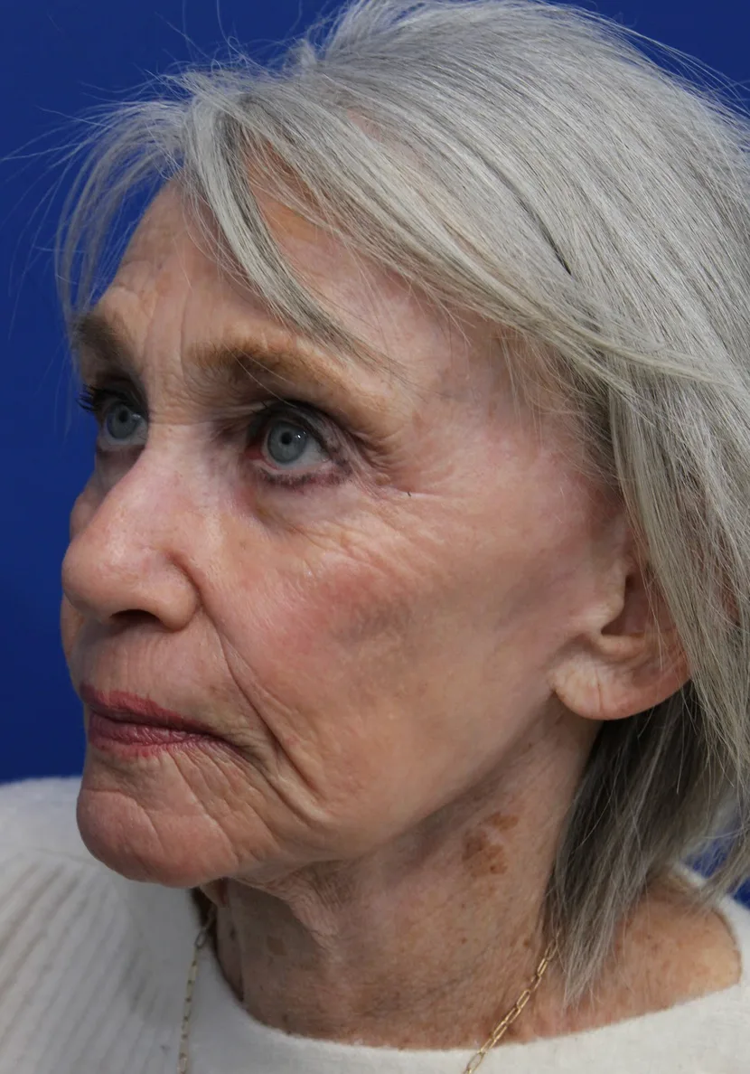 Laser Resurfacing Before & After Patient #5091
