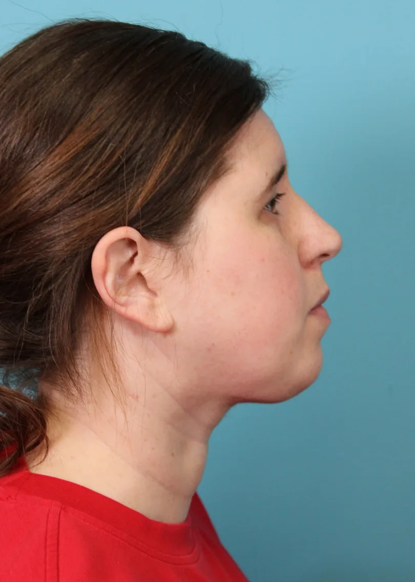 Submental Liposuction Before & After Patient #5074