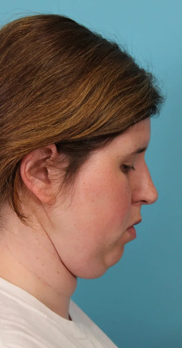 Submental Liposuction Before & After Patient #5074