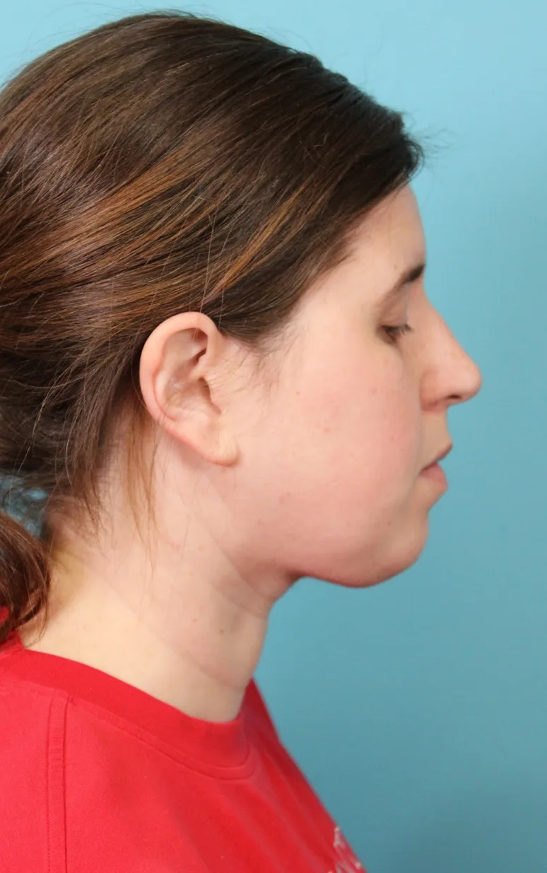 Submental Liposuction Before & After Patient #5074