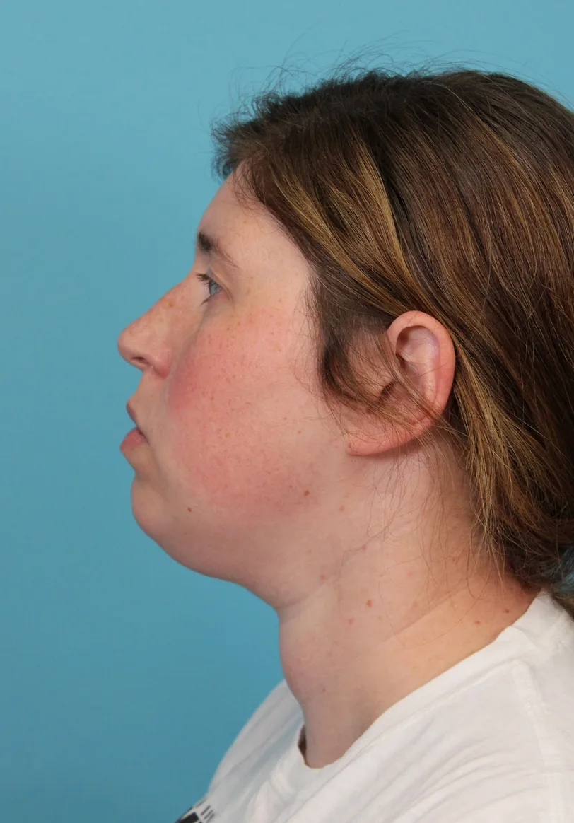 Submental Liposuction Before & After Patient #5074