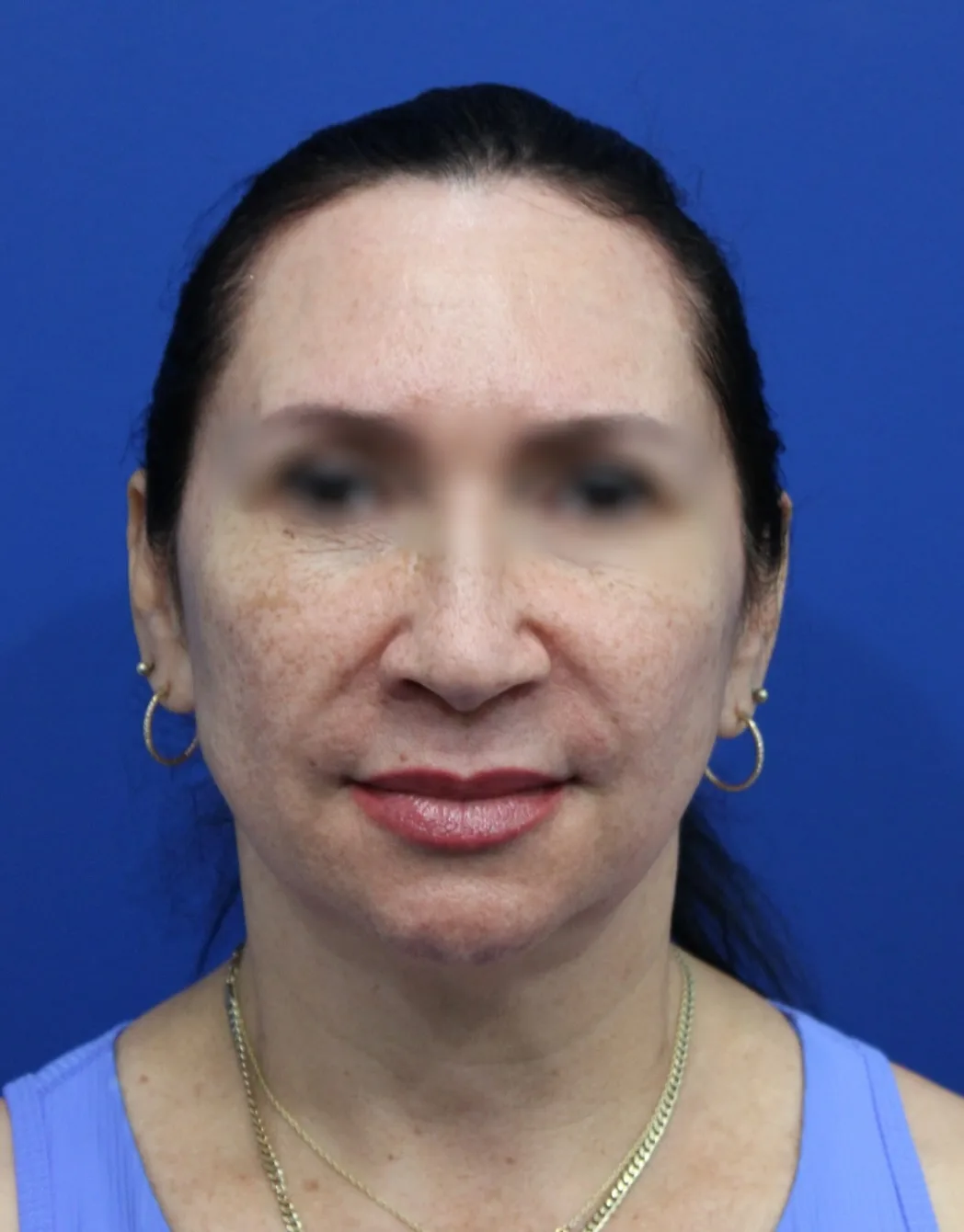 Facelift Before & After Patient #5150