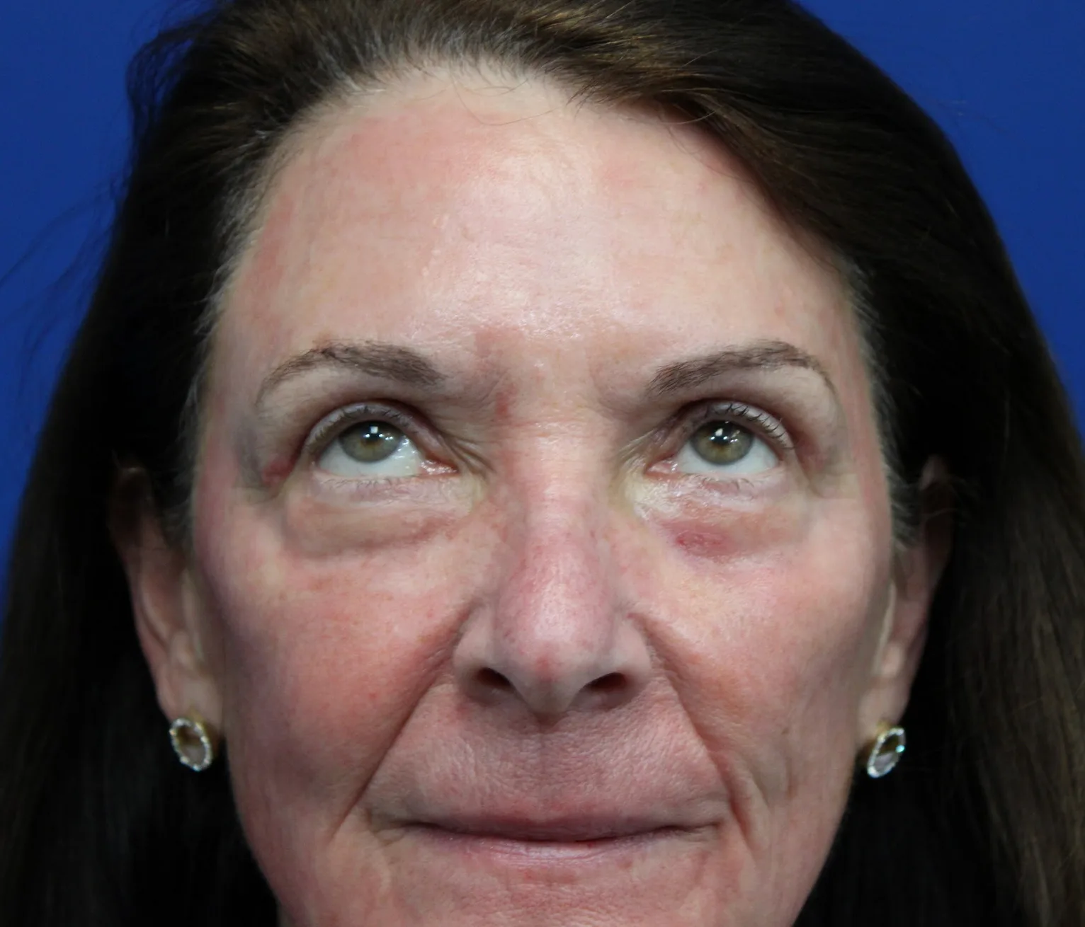 Upper Blepharoplasty Before & After Patient #5193