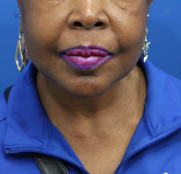 Facelift Before & After Patient #5149