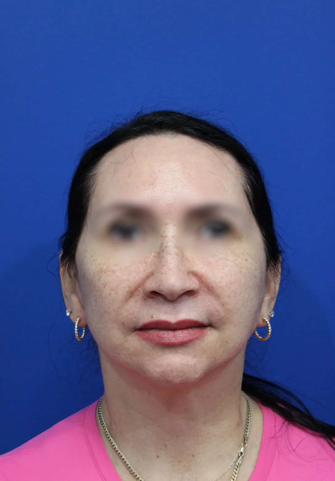 Facelift Before & After Patient #5150