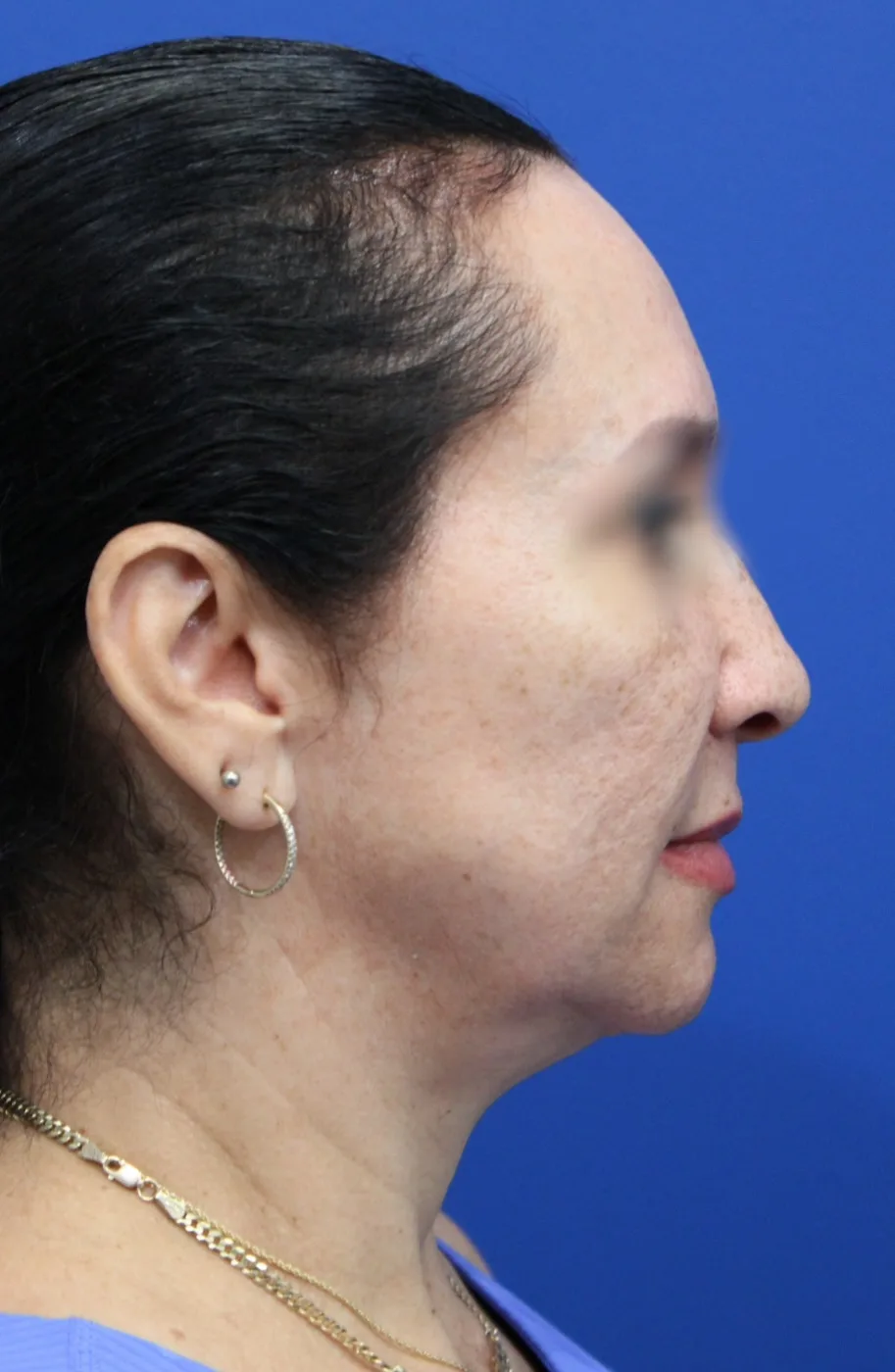 Facelift Before & After Patient #5150