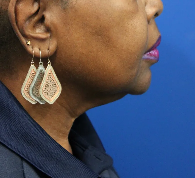 Facelift Before & After Patient #5149