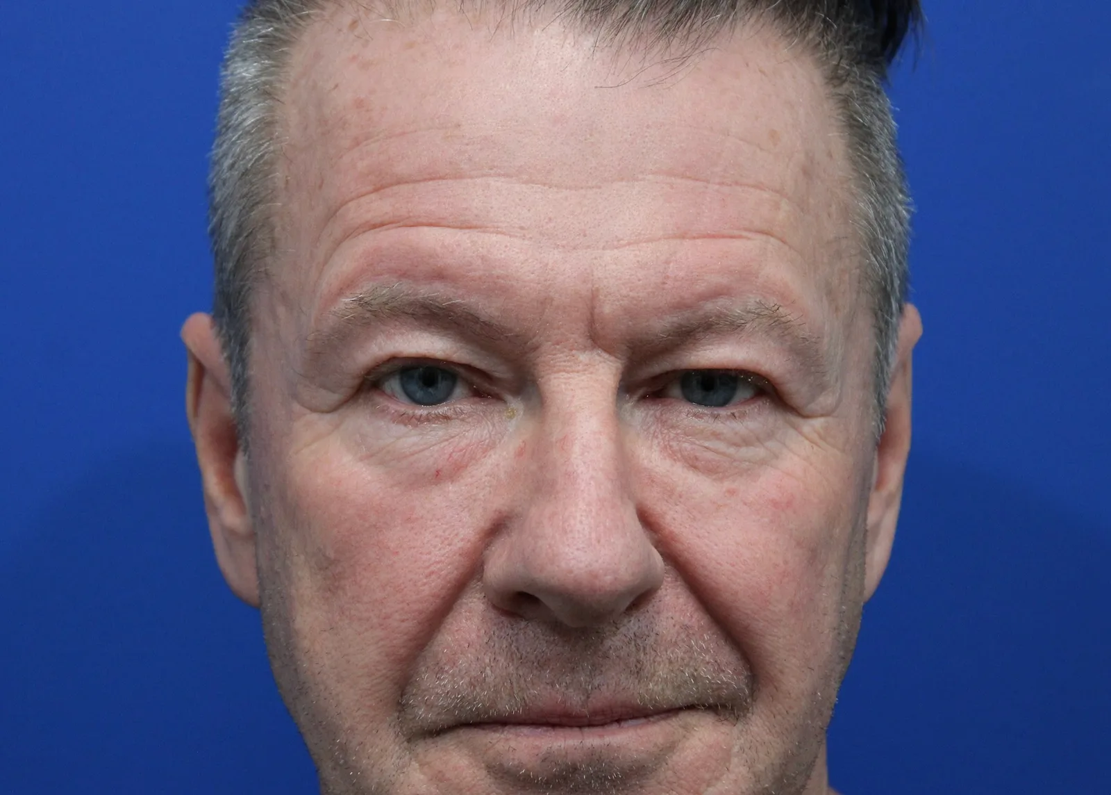 Upper Blepharoplasty Before & After Patient #5147